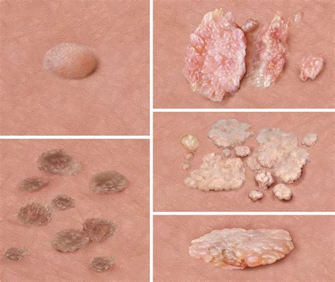 Genital warts | informedhealth.org