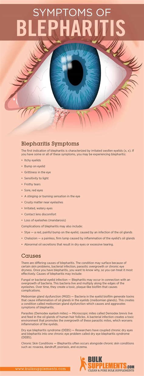 Tablo | Read 'Blepharitis Symptoms, Causes & Treatment' by