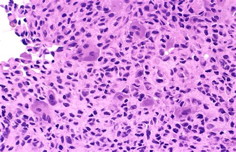 Chondroblastoma - Libre Pathology