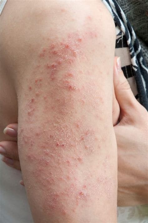 What is the Skin Rash, Dermatitis Herpetiformis? - Allergic Living