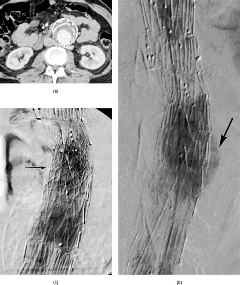 Primary Endovascular Repair of Juxtarenal Aneurysms with Fenestrated ...