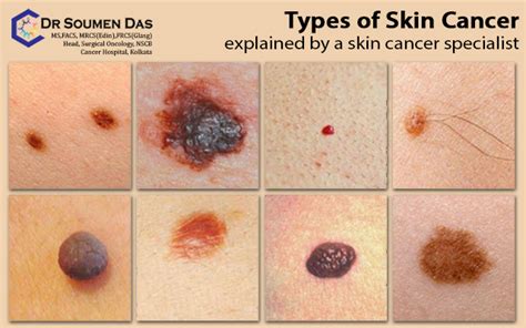 Skin Cancer Types