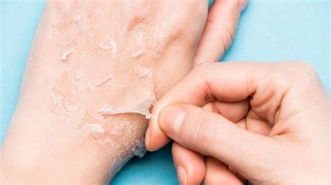 Dry peeling skin: 7 home remedies you can try | HealthShots