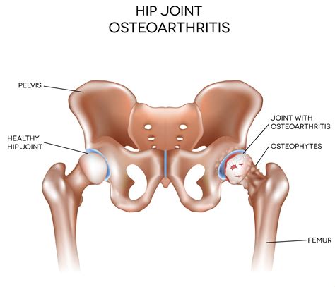 Stages of Osteoarthritis of the Hip | LifeMD