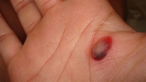 Blood Blisters: Symptoms, Causes, and Treatment