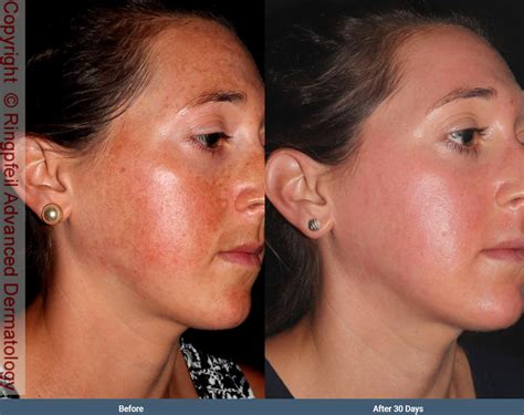 Melasma Before After