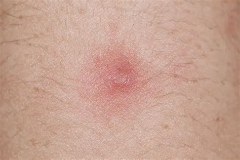 What is Folliculitis? Causes and Treatments - DermaBlue