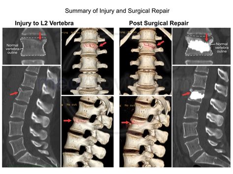 L2 Vertebral Body Compression Fracture and Surgical Repair – Medmovie.com