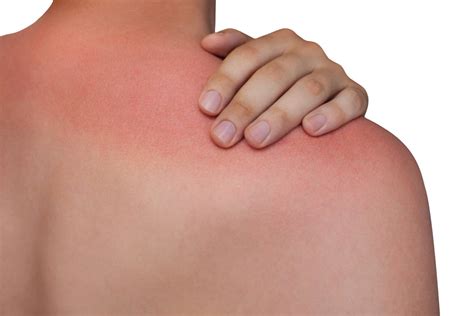 Sun Damage Treatment Dallas TX - Sun Damage Causes