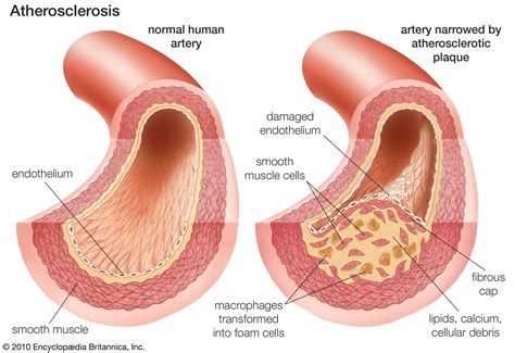 Atherosclerosis Diagram