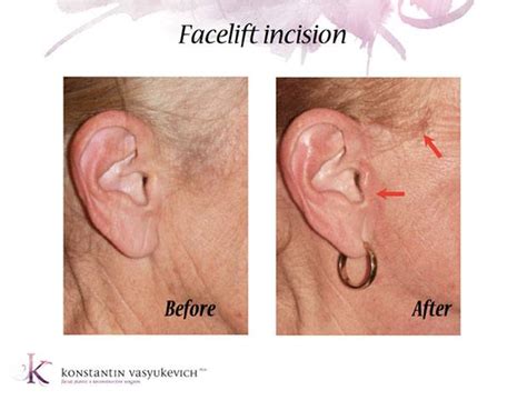 The Evolution of Facelift Incisions | Manhattan, NYC Specialist ...