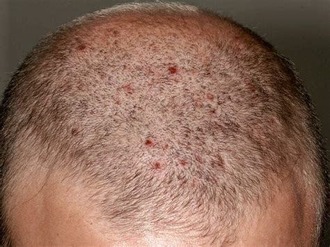 Severe Dandruff Scalp