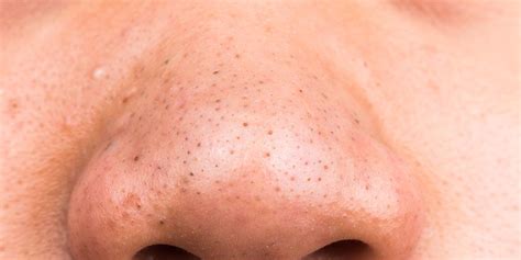 Ask Dr. Pimple Popper: How To Treat Blackheads | Women's Health