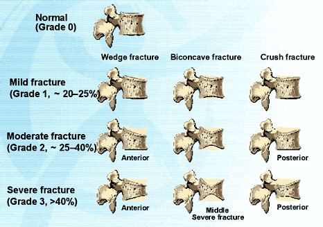 RadiologySpirit: grading of vertebral wedge fracture