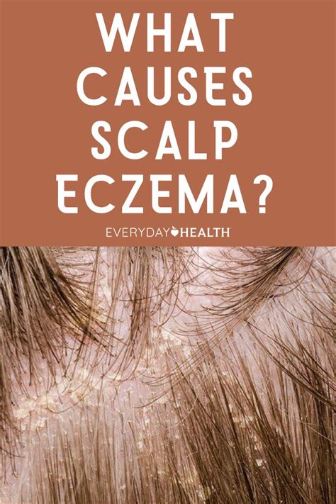 How To Hide Scalp Eczema Tips And Tricks - The 2023 Guide to the Best ...