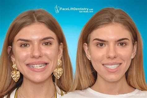 Before and After photos showing Underbite Correction, Overbite ...