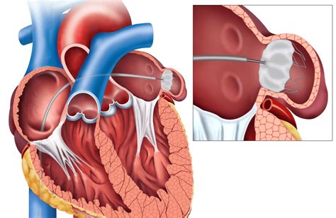 Watchman Device - The Heart Rhythm Institute of Arizona