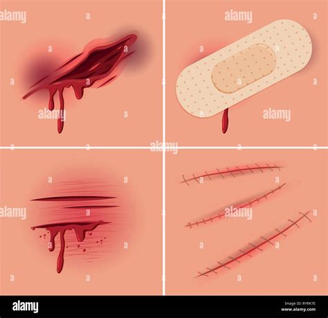 Set of fresh wound illustration Stock Vector Image & Art - Alamy