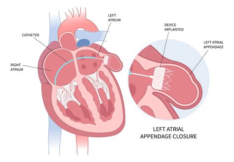 WATCHMAN Device Explained: Benefits, Procedure, and More | Dr. AFib