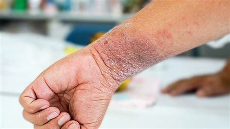 10 domande comuni sull’impetigine, risposte | salutedintorni.it