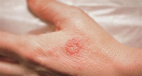 Nummular Eczema: Causes, Diagnosis, and Effective Treatments