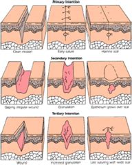 NPCC RN U1 Wound Healing Flashcards | Quizlet
