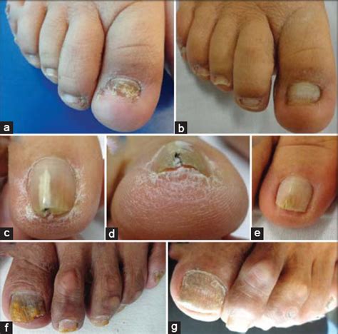 Total Dystrophic Onychomycosis