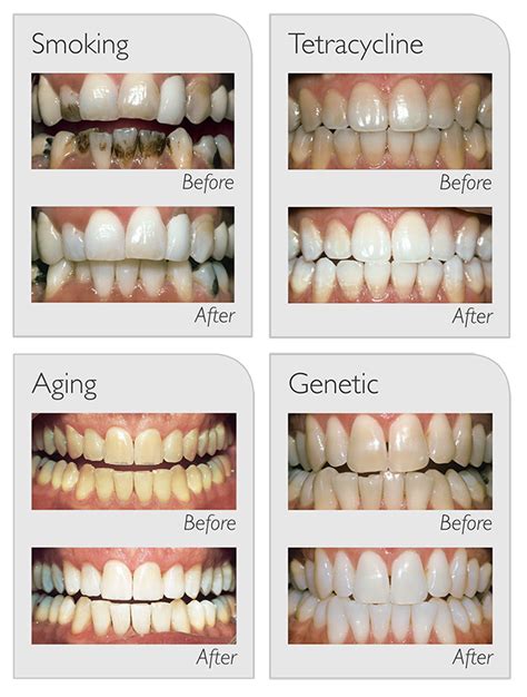 Teeth Whitening : Special Care Dental