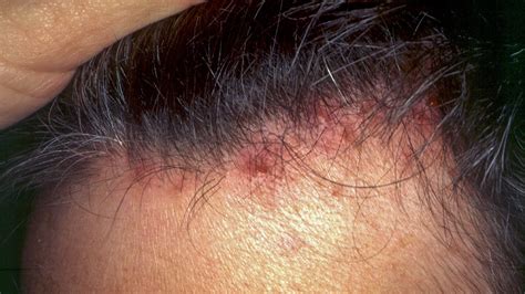 Red Scalp And Hair Loss Bumps On The Scalp Causes Symptoms And | Images ...