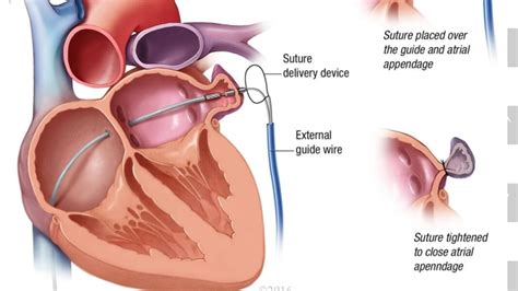 Leaks after percutaneous left atrial appendage occlusion and stroke ...