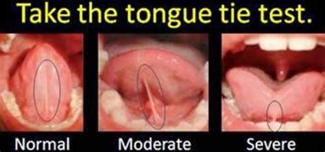 tongue tie Archives - Spectrum Chiropractic Natural Family Healthcare