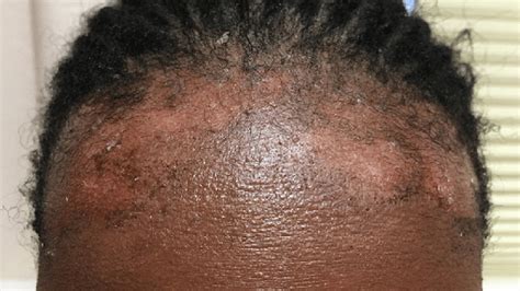 Eczema On Scalp African American