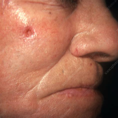 Rodent Ulcer on Patient's Cheek - Stock Image - C022/2114 - Science ...