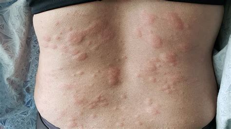 7 Surprising Triggers of Chronic Hives | Everyday Health