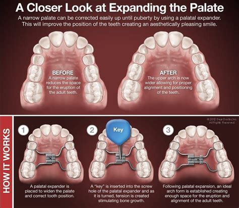 Palatal Expander