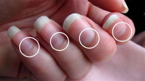 Lunula definition, lunula function & nail problems