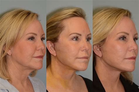 Before and After Facelift & Neck Lift Photos