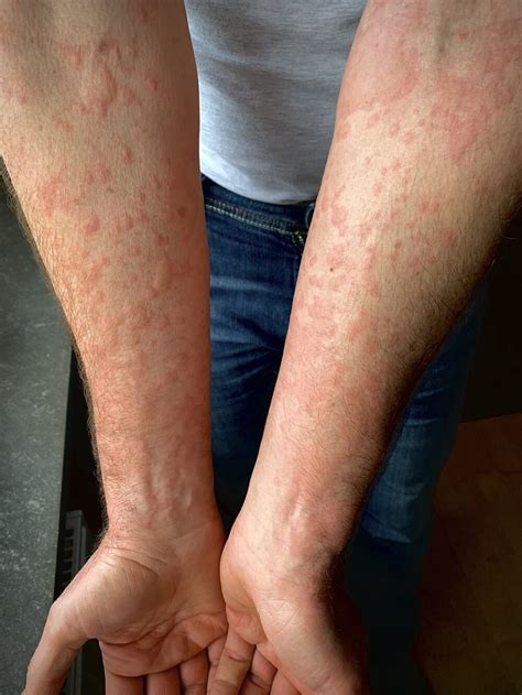 Urticaria Treatment