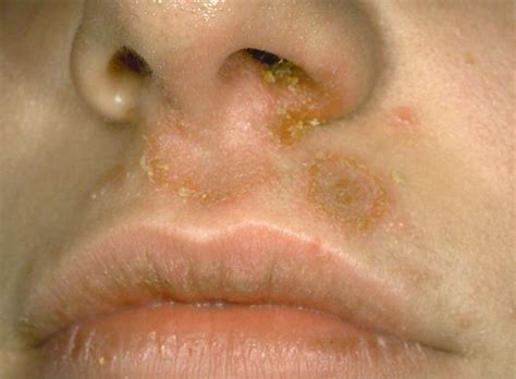 Staph Infection On Lips Symptoms | Lipstutorial.org