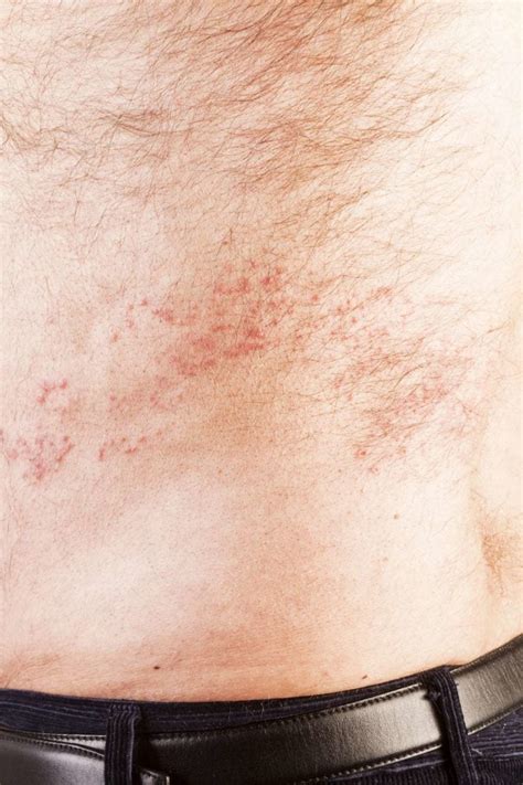 Mild Shingles Rash On Arm