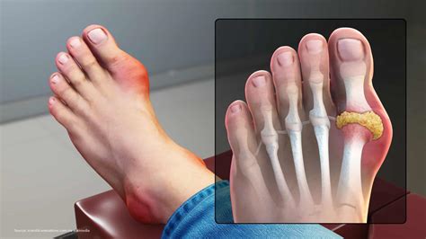 9 Pictures of the Gout: Symptoms, Food to avoid, other tips