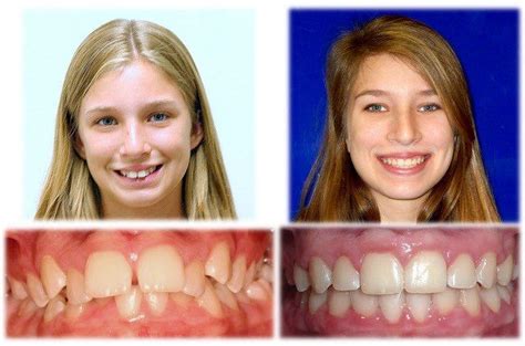 Before and after pics of patient treated for overbite...you can see the ...