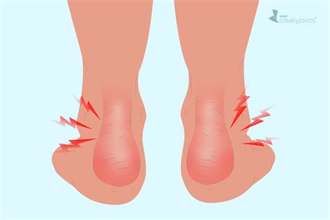 Psoriatic Arthritis in the Ankle: Symptoms, Causes, Treatments