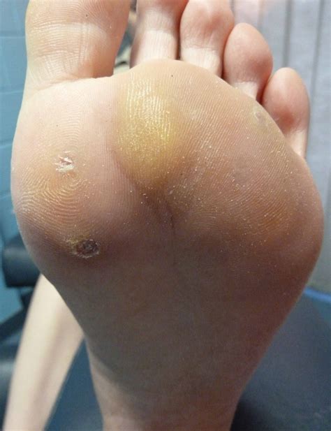 Plantar Wart Removal – Warts