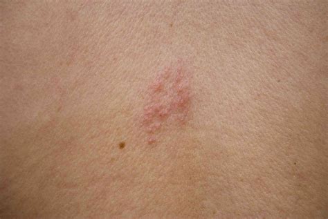 What Does Shingles Look Like? Shingles Rash Pictures