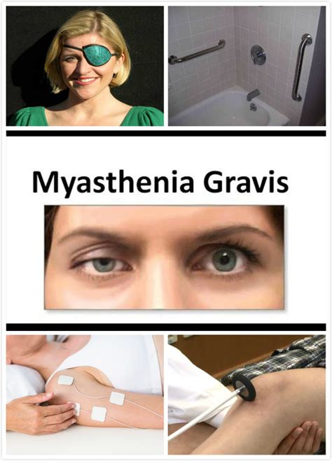 Myasthenia Gravis Diagnosis | New Health Advisor