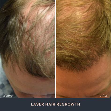 Laser Hair Regrowth Treatment | Novuskin