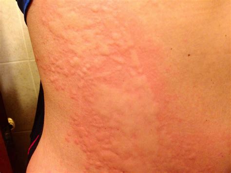 Pictures Of Hives Rash On Skin | Images and Photos finder