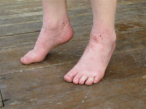 Red Skin Rash On Top Of Foot | Images and Photos finder