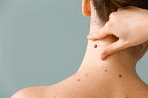 Moles on the Body and Melanoma Skin Cancer: What’s the Link?